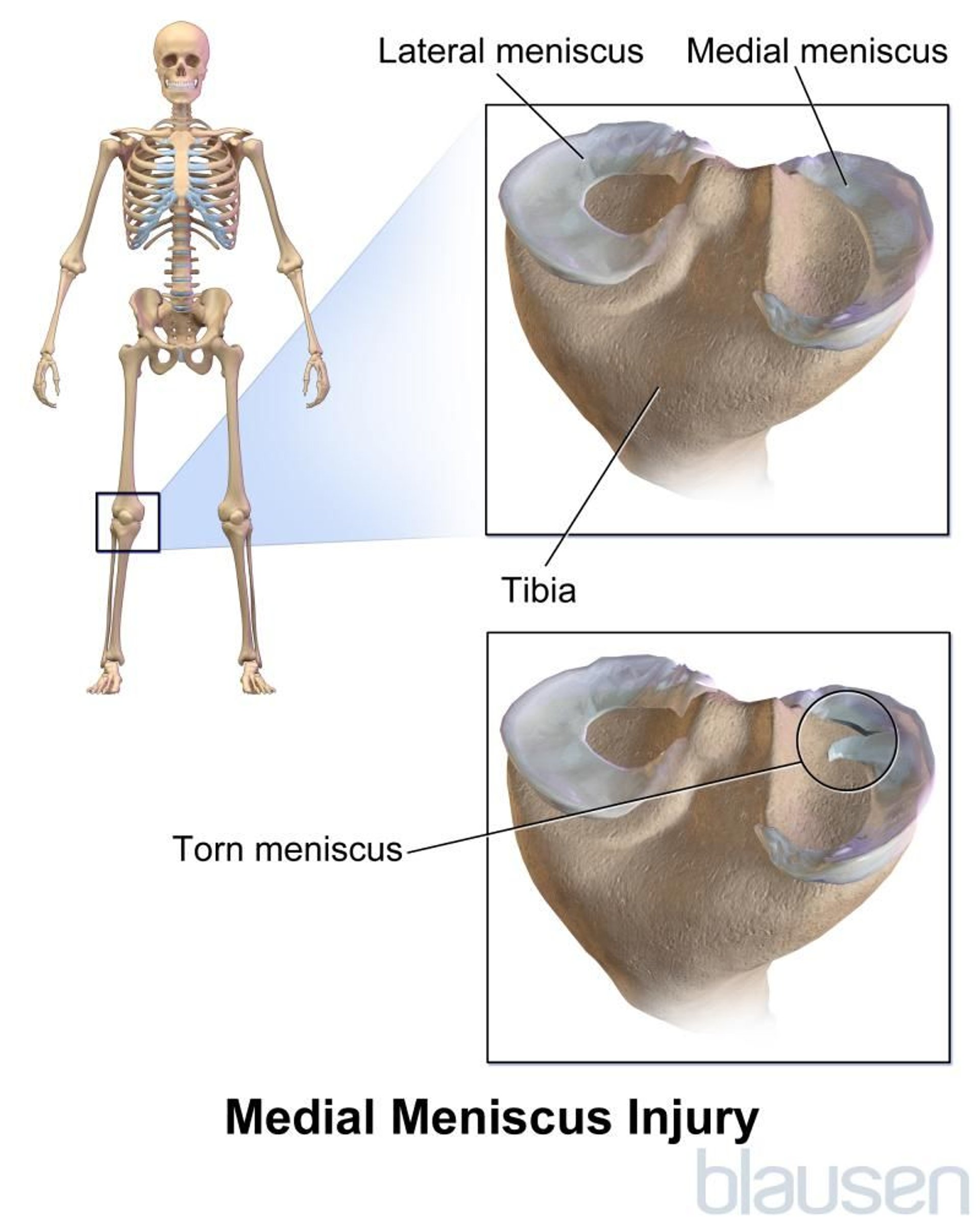 Medial Meniscus Injury