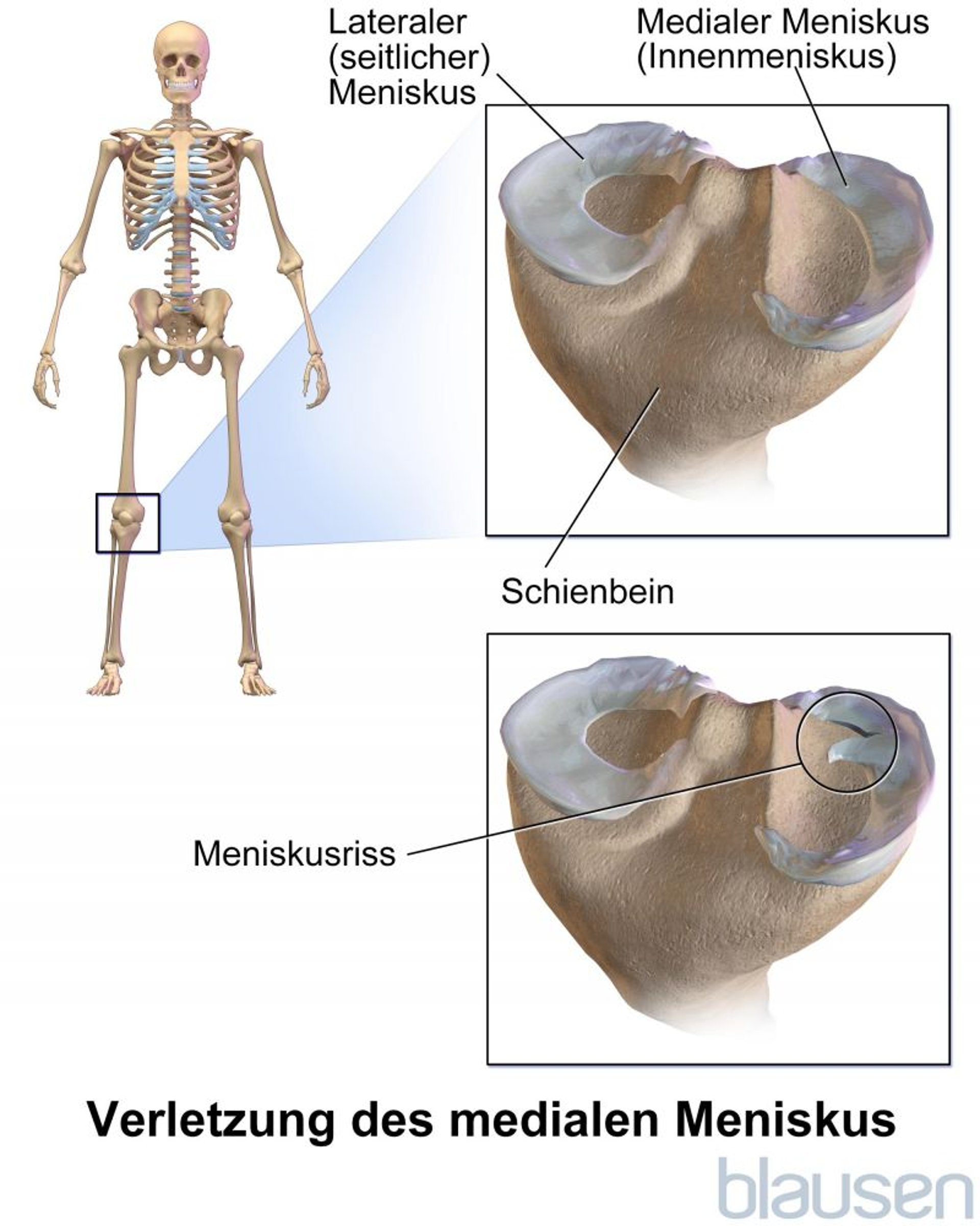 Verletzung des medialen Meniskus