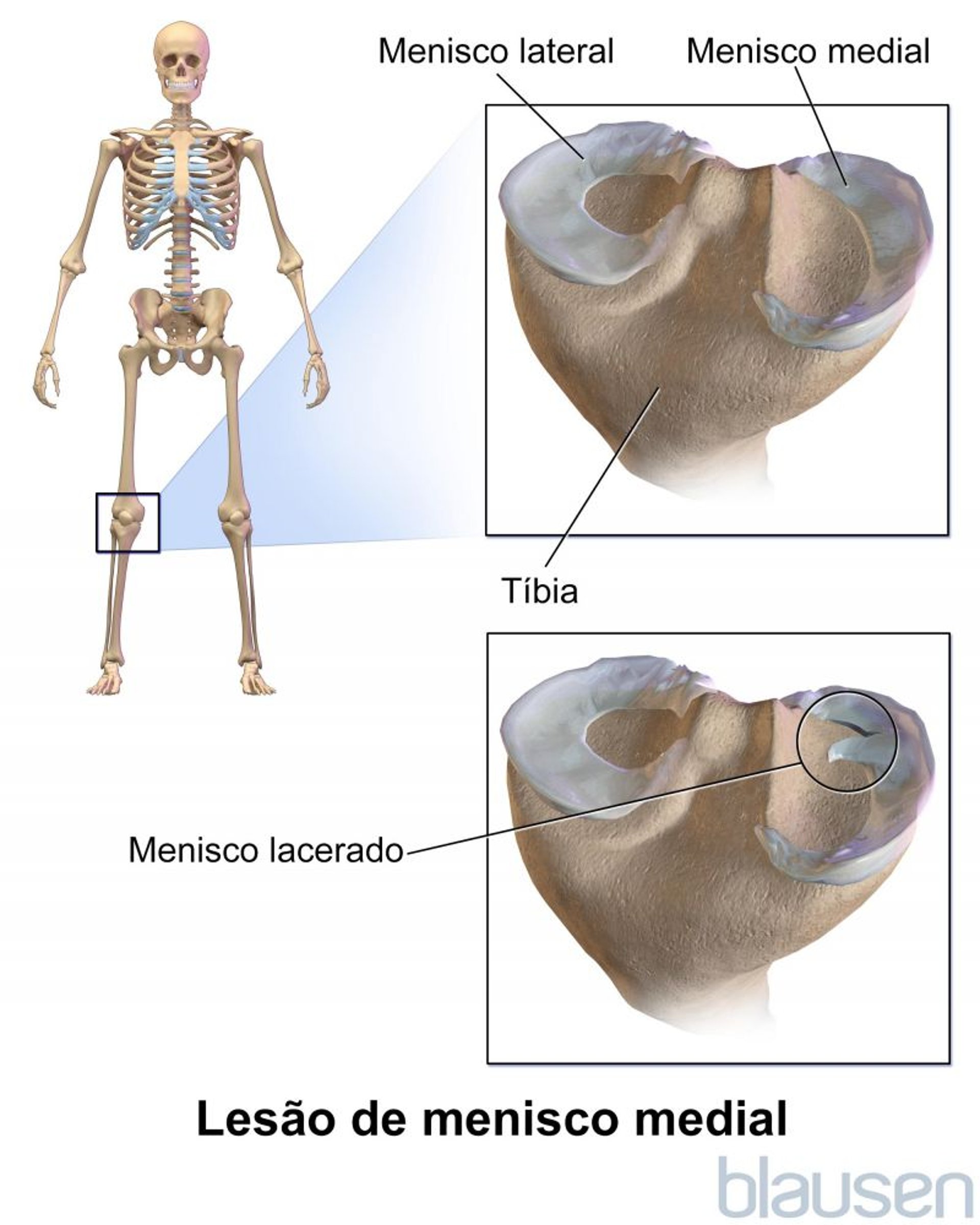 Lesão de menisco medial