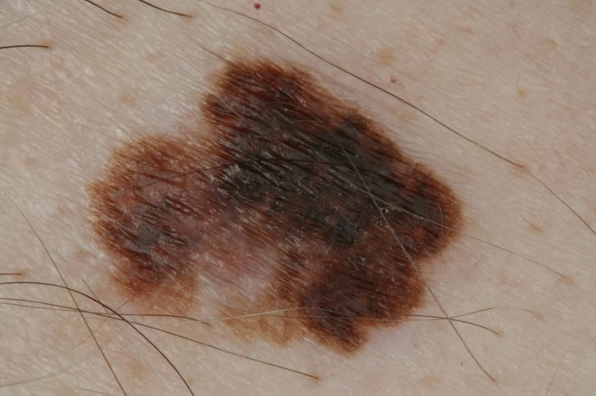 Melanoma de diseminación superficial