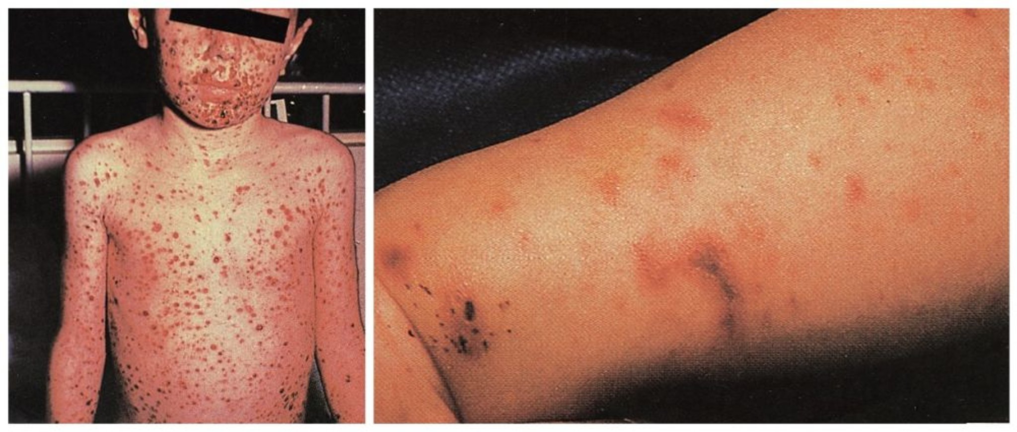 Ausgedehnter Hautausschlag infolge einer Infektion im Blutkreislauf durch Meningokokken