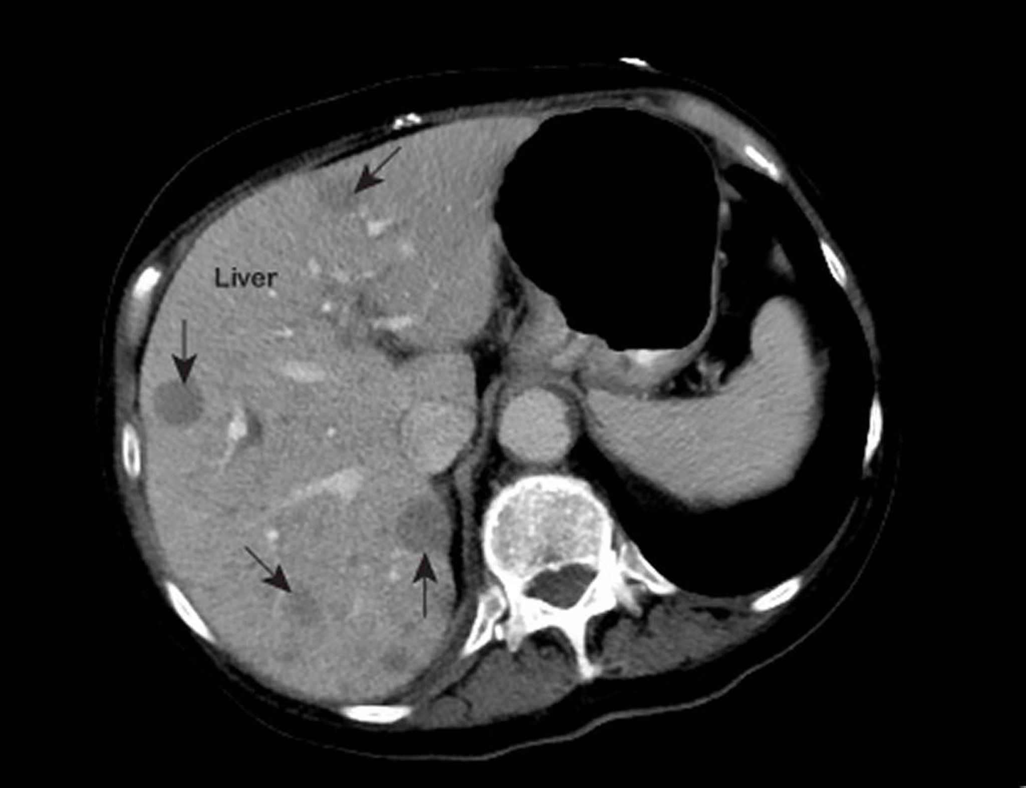 Cáncer metastásico de hígado