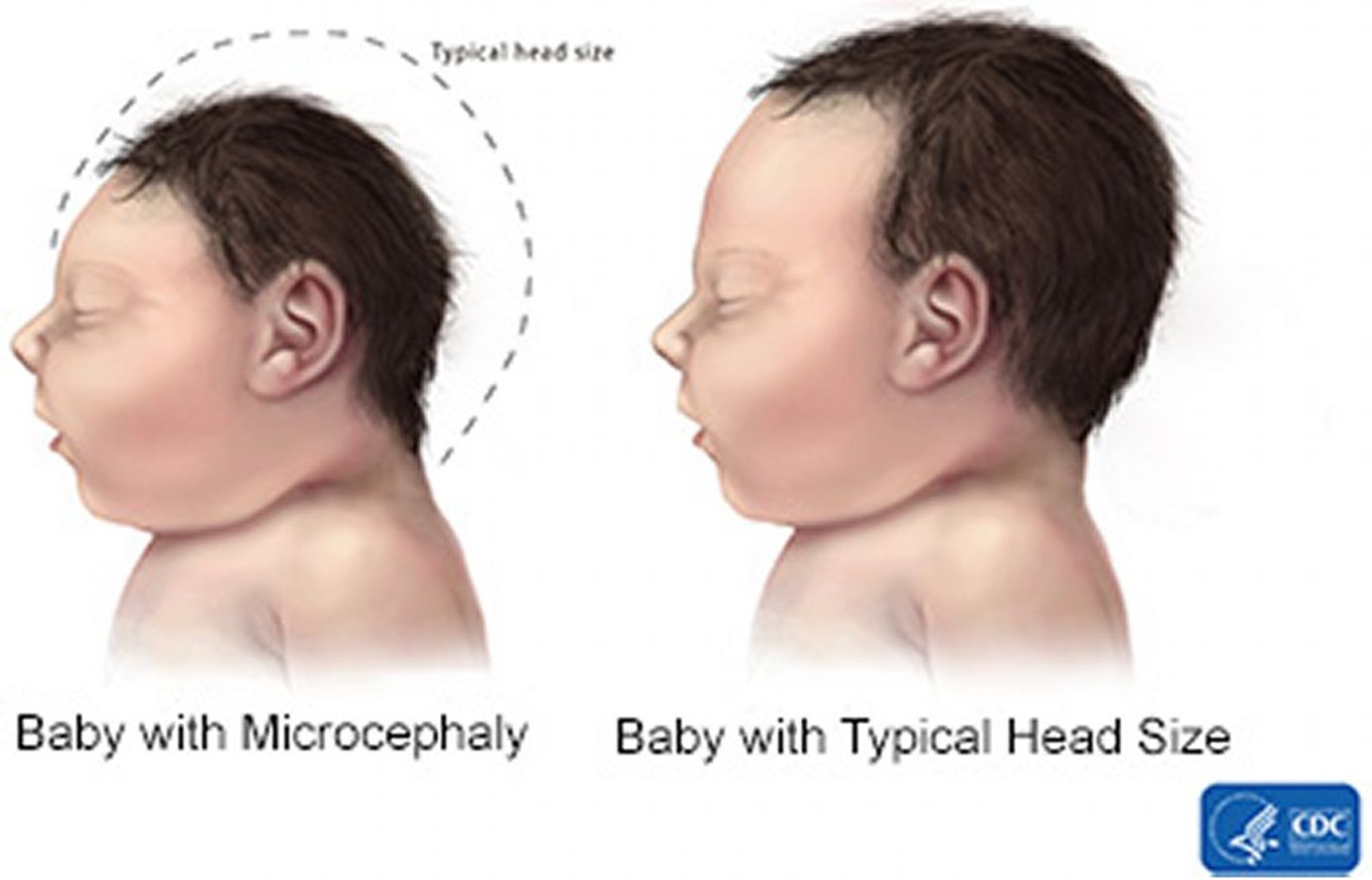 Microcefalia (comparación del tamaño de la cabeza)