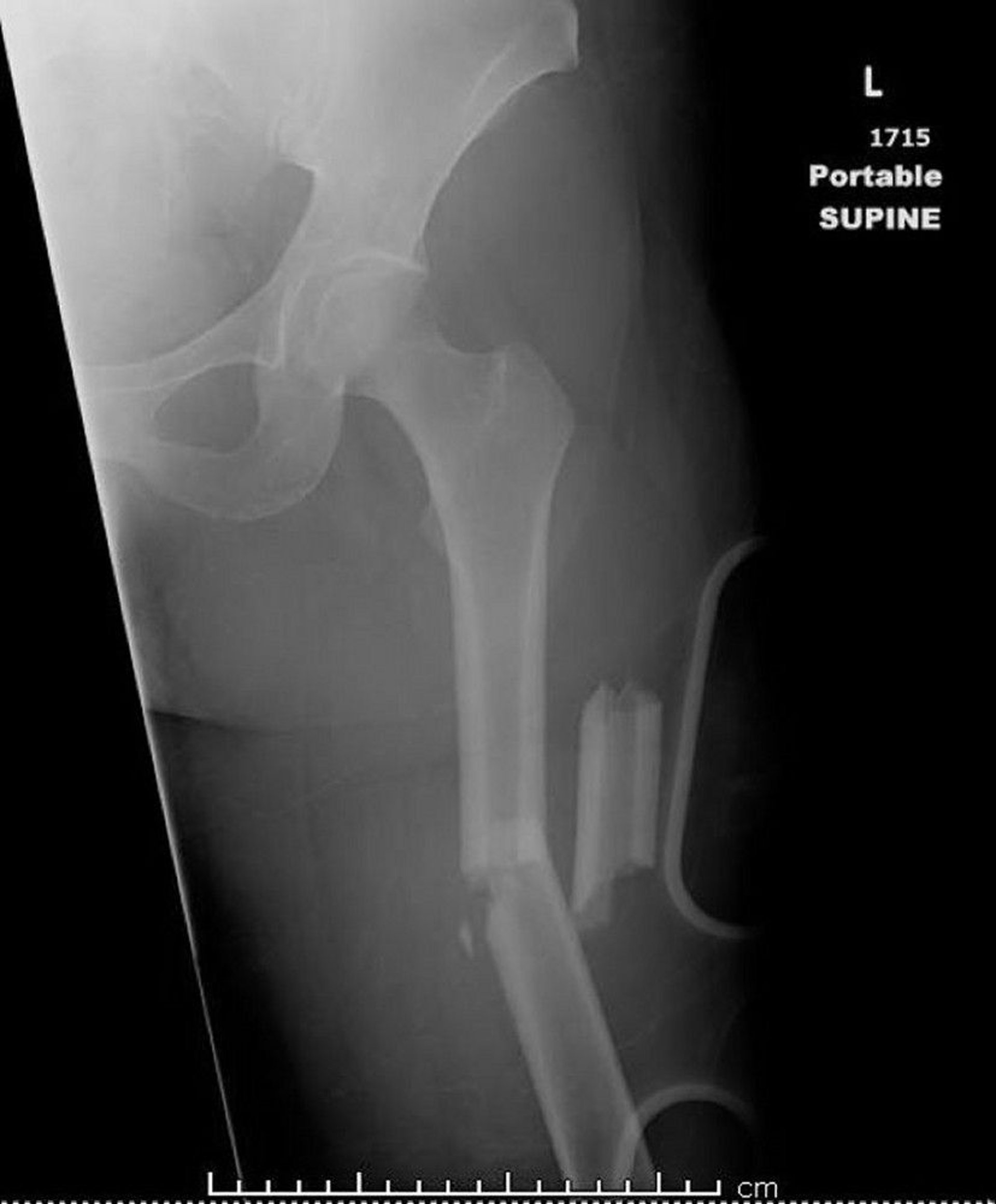 Midshaft Thighbone Fracture