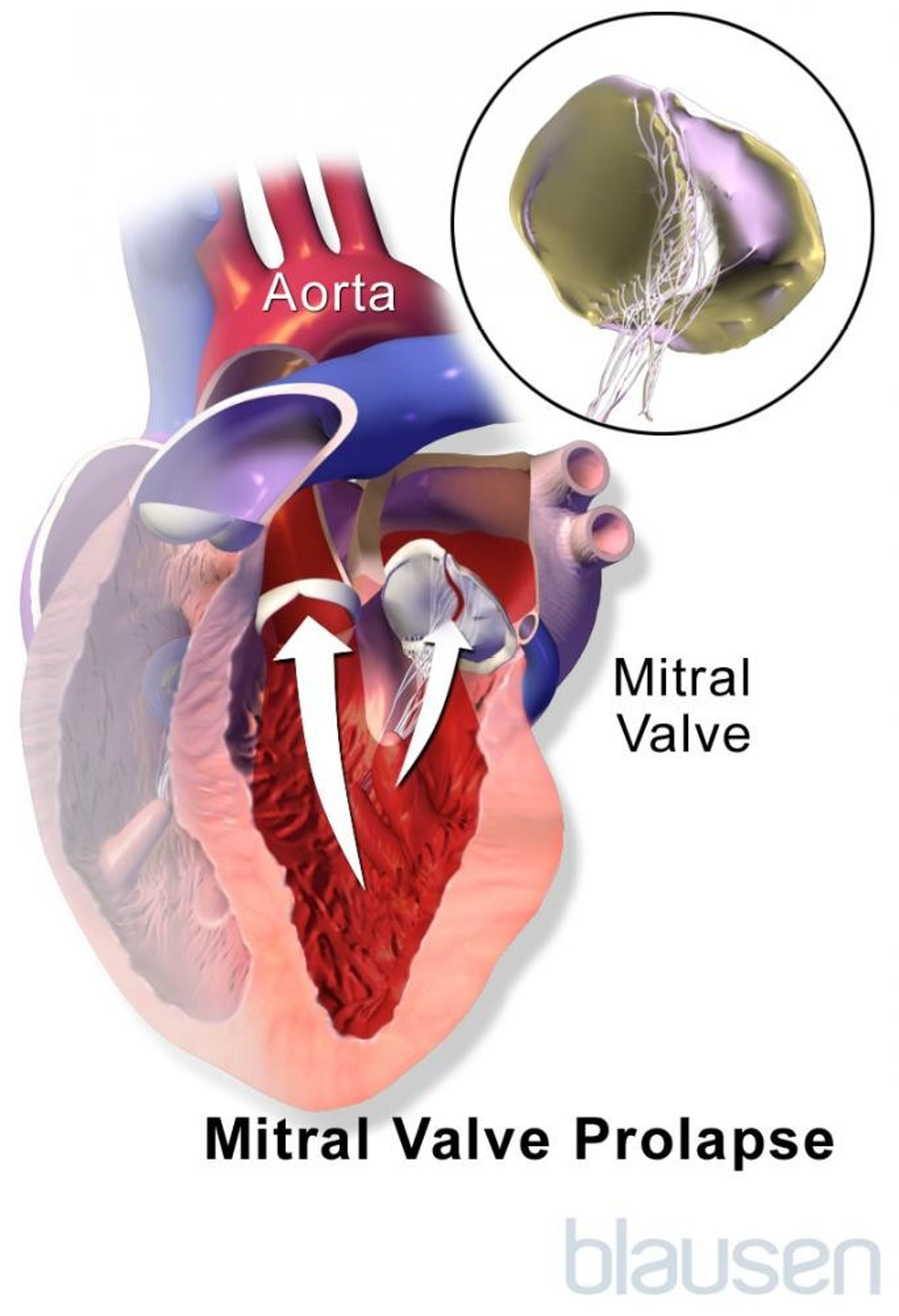 Mitral Valve Prolapse