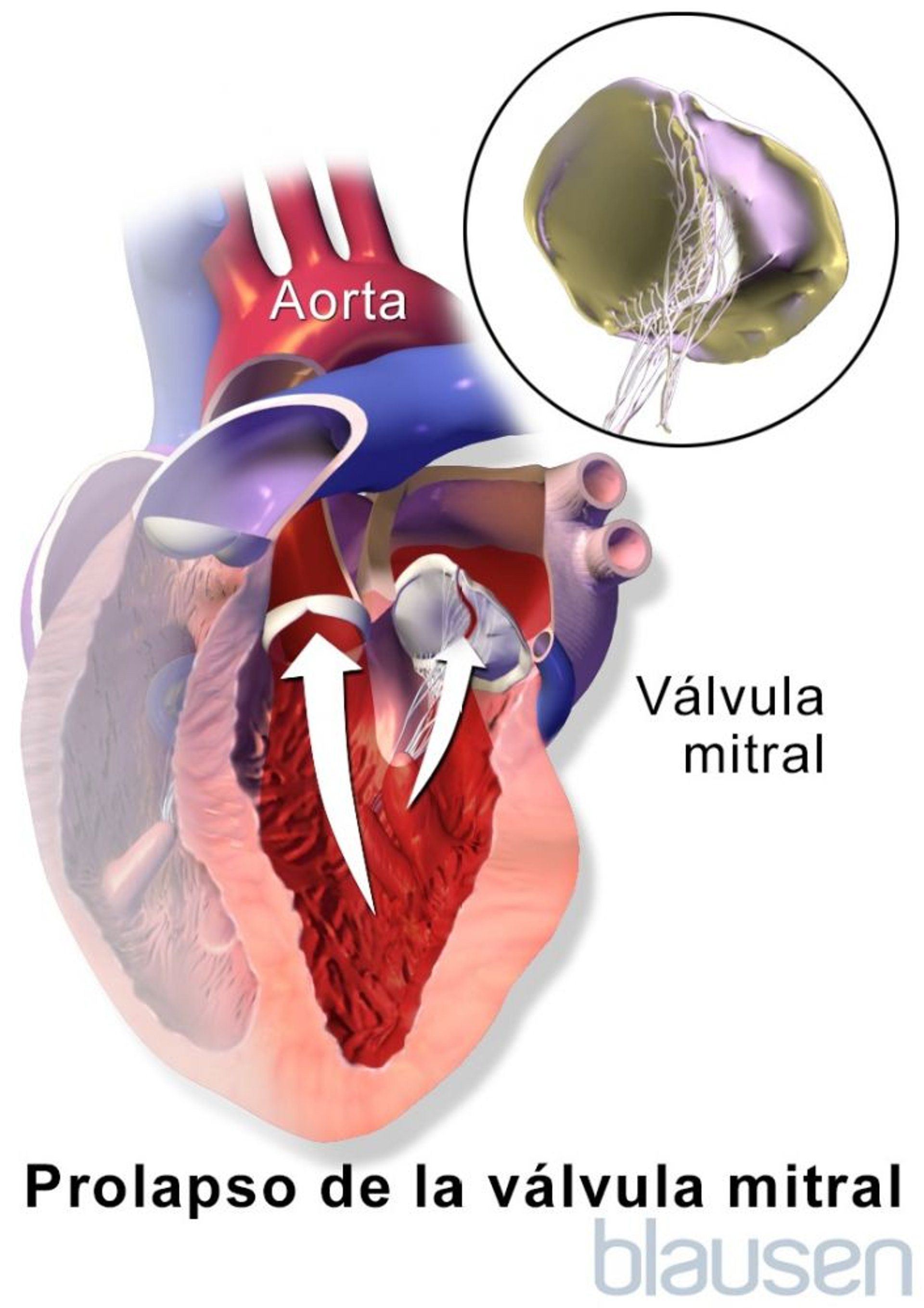 Prolapso de la válvula mitral