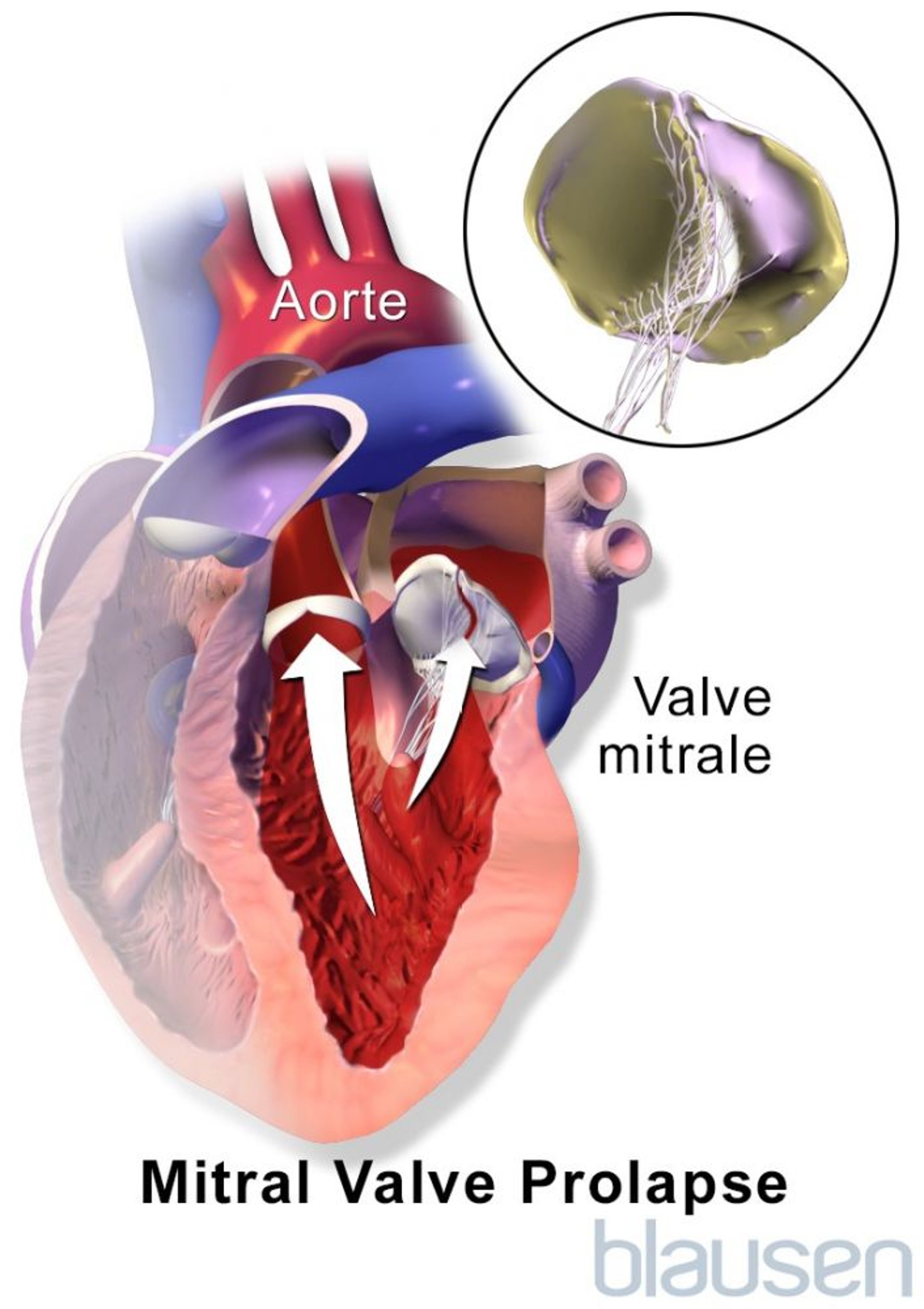 Prolapsus de la valvule mitrale