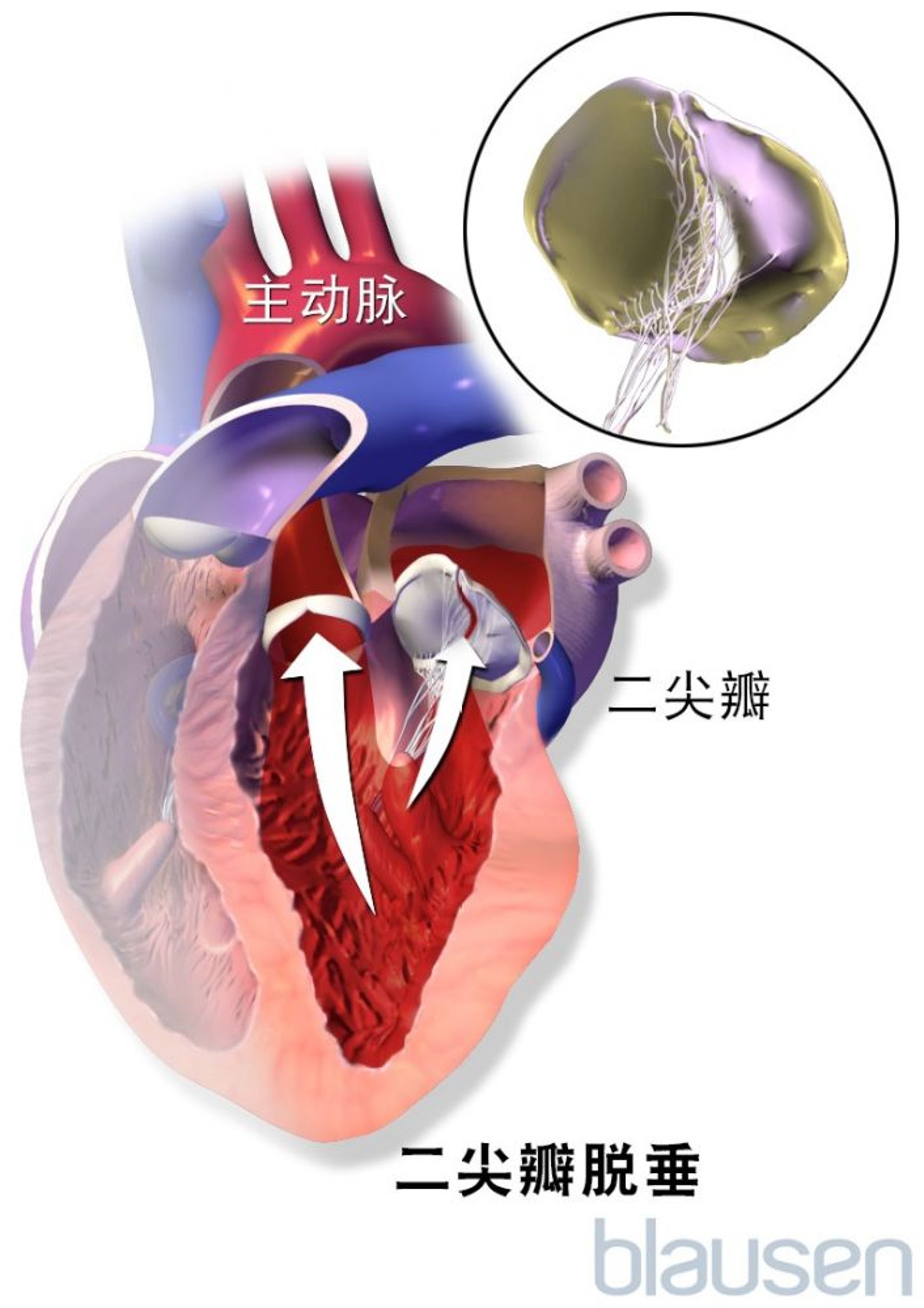 二尖瓣脱垂