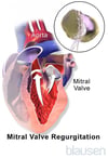Mitral Valve Regurgitation