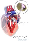 قلس الصمام المترالي