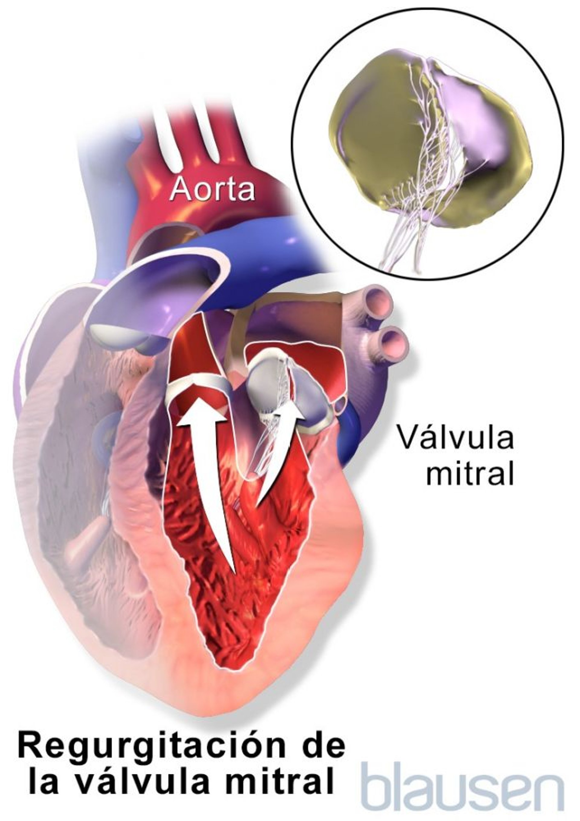 Regurgitación de la válvula mitral