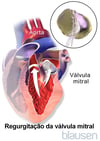 Regurgitação da válvula mitral