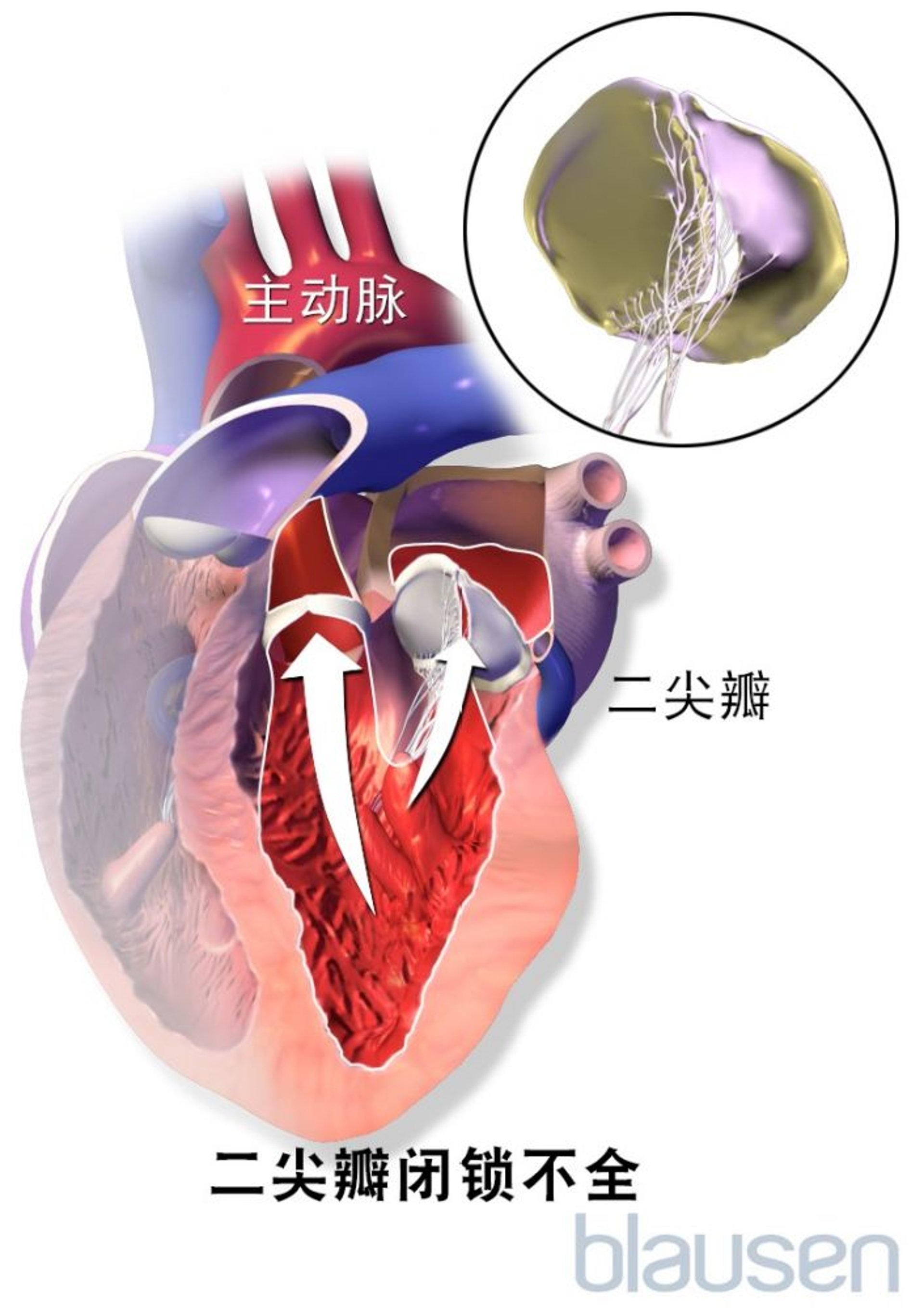 二尖瓣闭锁不全