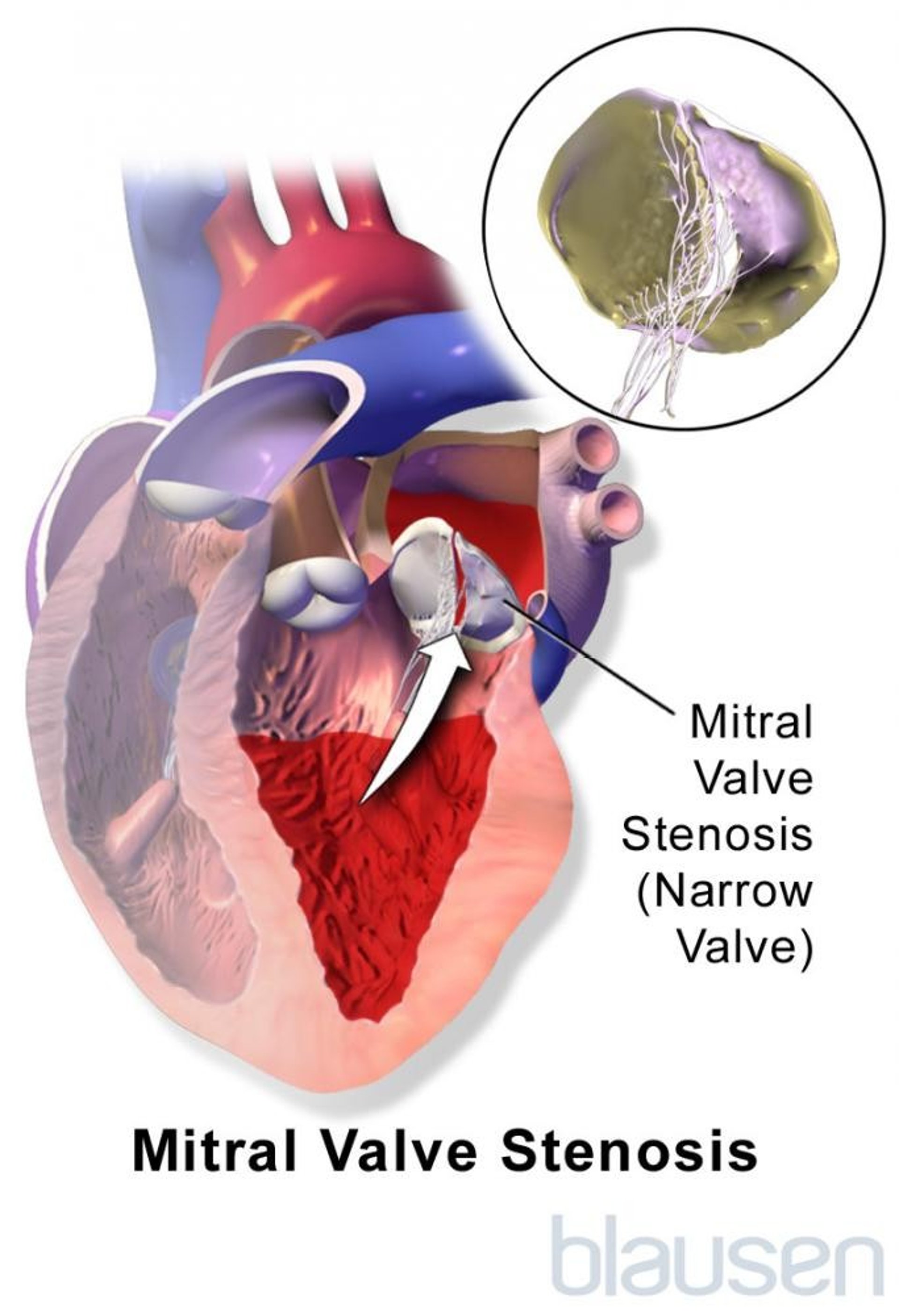 Mitral Valve Stenosis