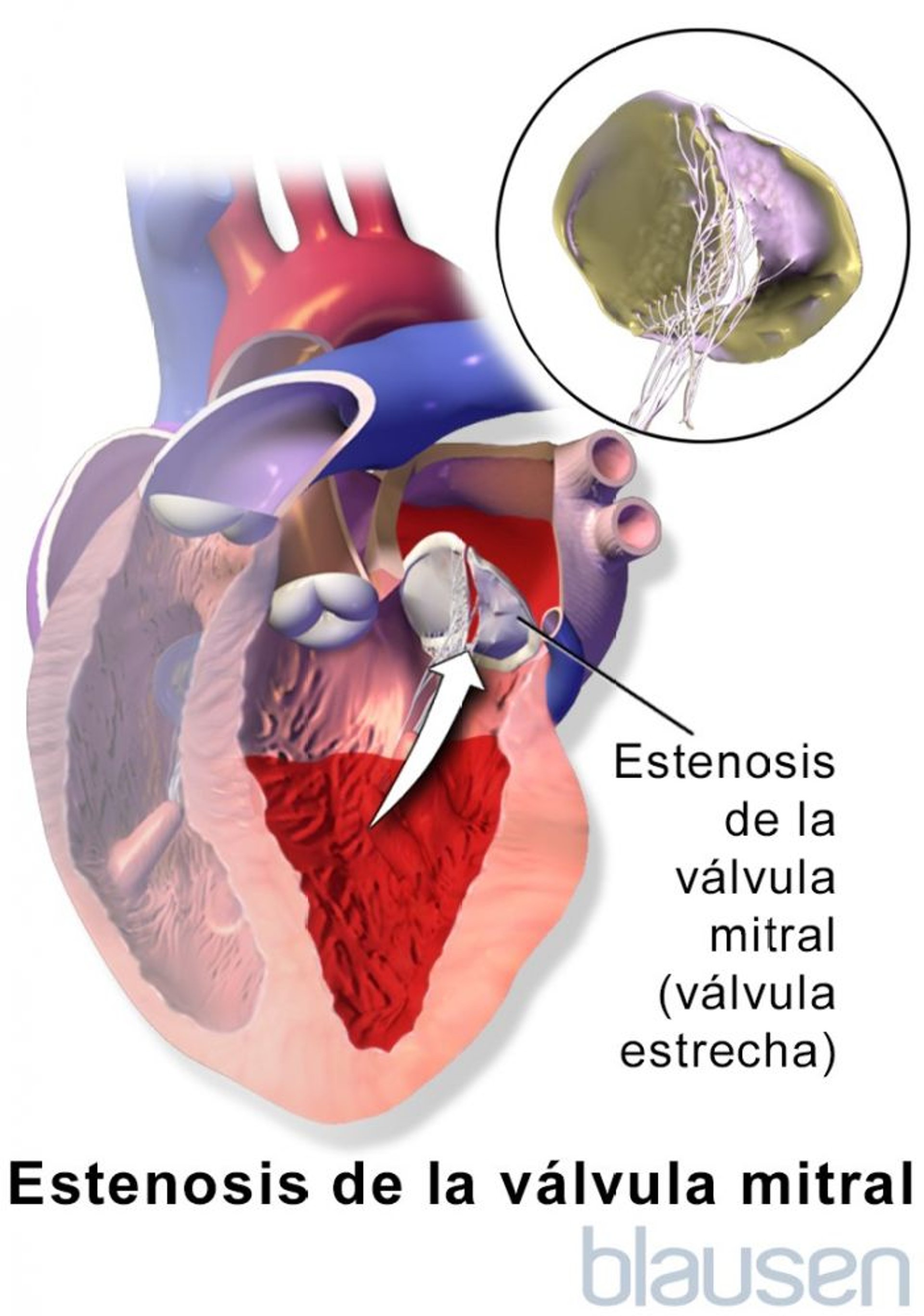 Estenosis valvular mitral