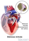 Sténose mitrale