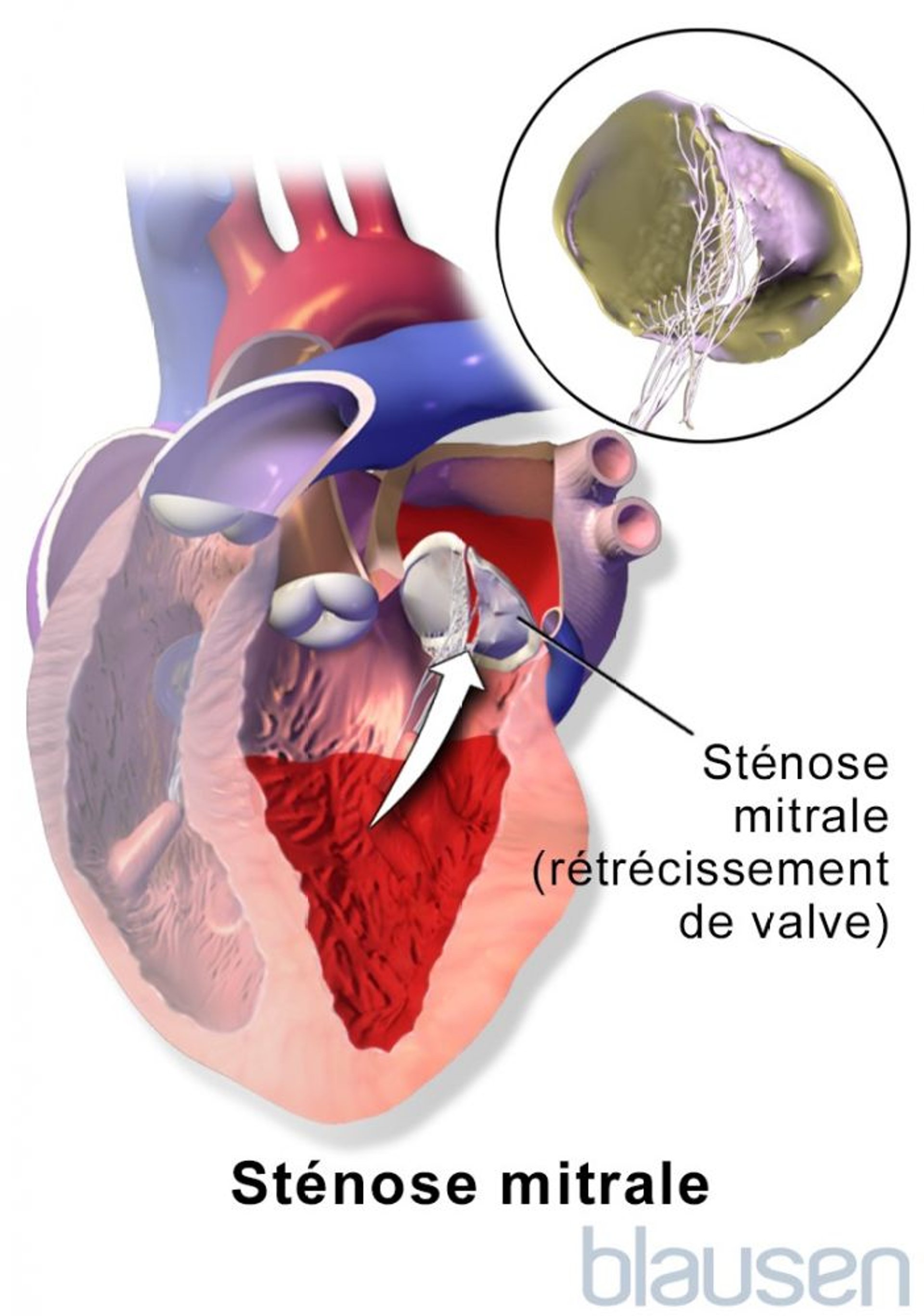 Sténose mitrale