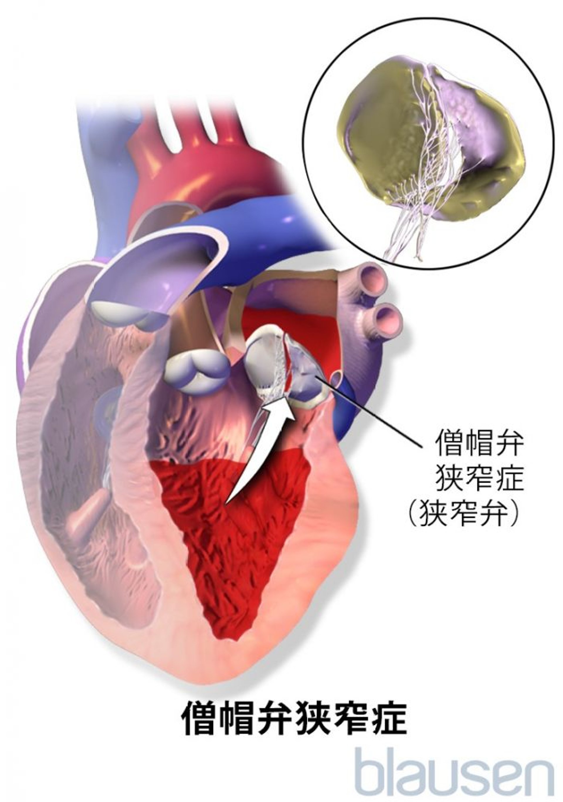 僧帽弁狭窄症