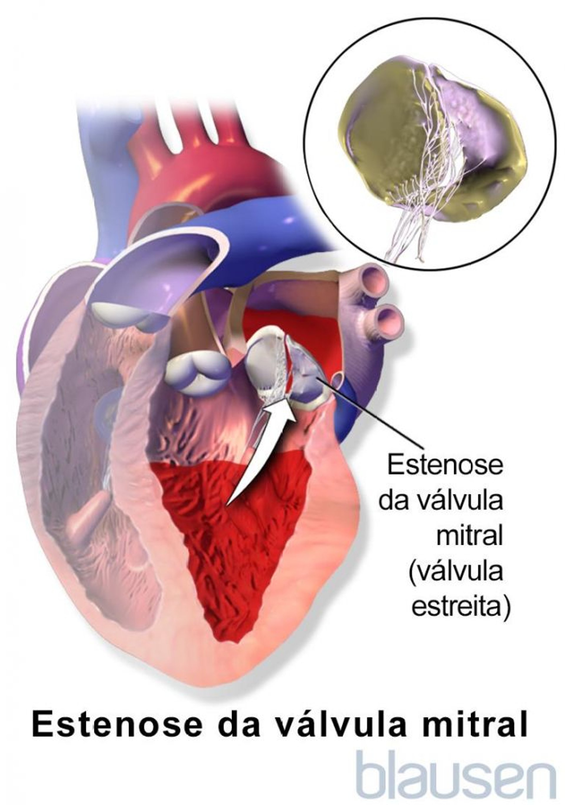 Estenose da válvula mitral