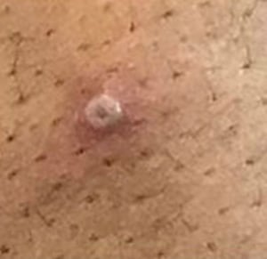 Mpox