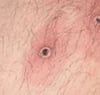 Mpox (5)