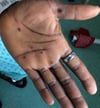 Mpox (3)