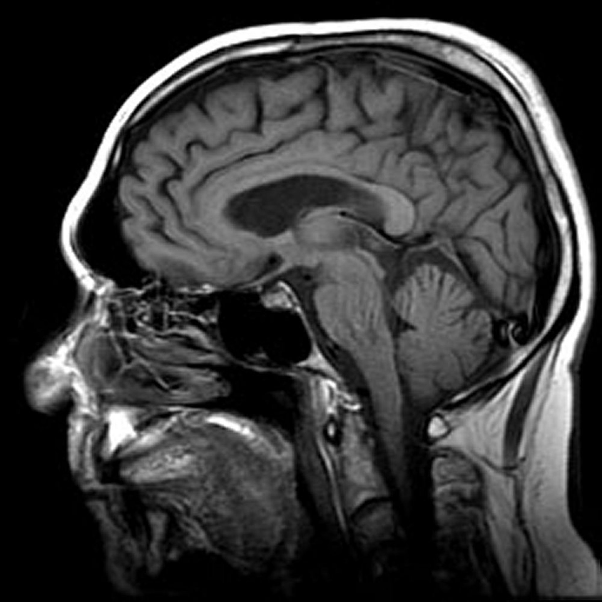 मस्तिष्क की मैग्नेटिक रेजोनैंस इमेज (MRI)