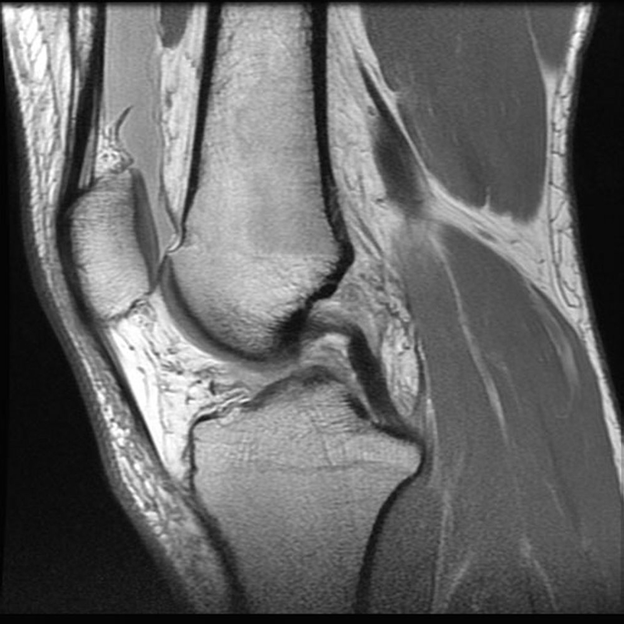 膝部磁共振成像(MRI)