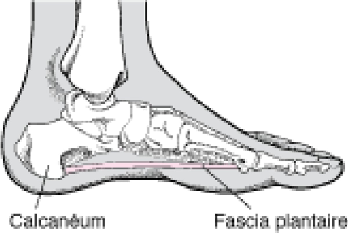 Fascia plantaire