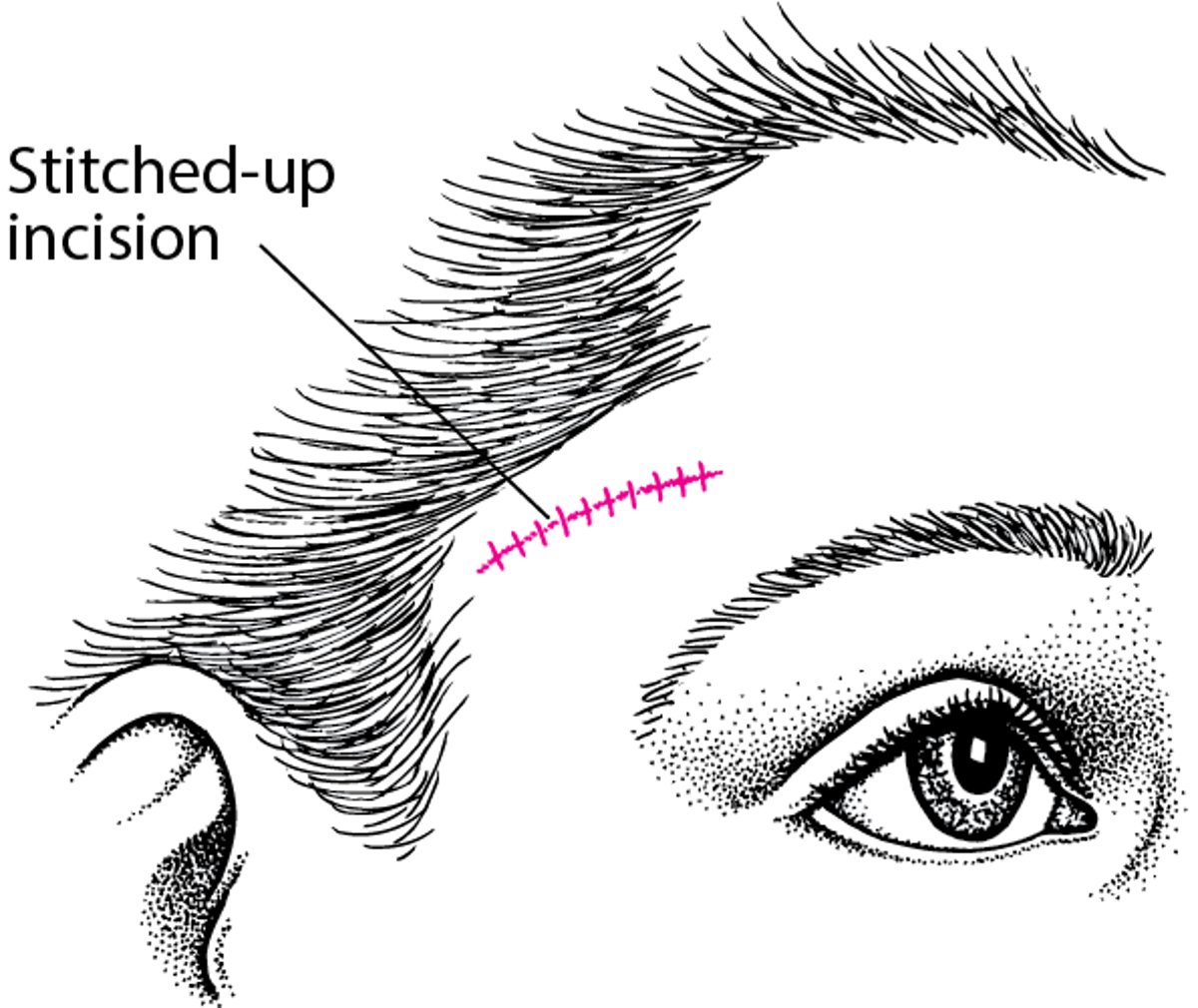 Biopsy of the Temporal Artery