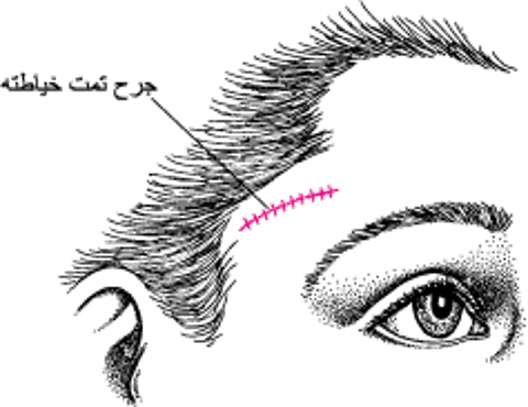 خزعة الشِّريان الصِّدغي