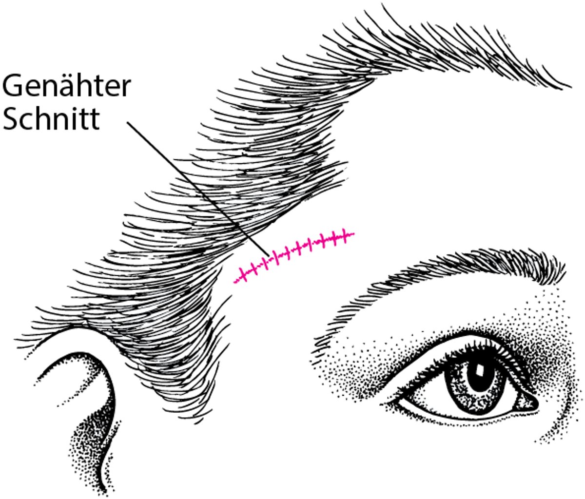 Biopsie der Schläfenarterie