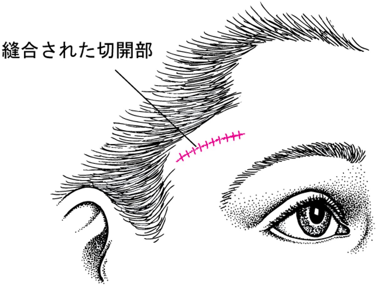側頭動脈の生検