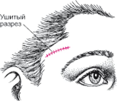 Биопсия височной артерии