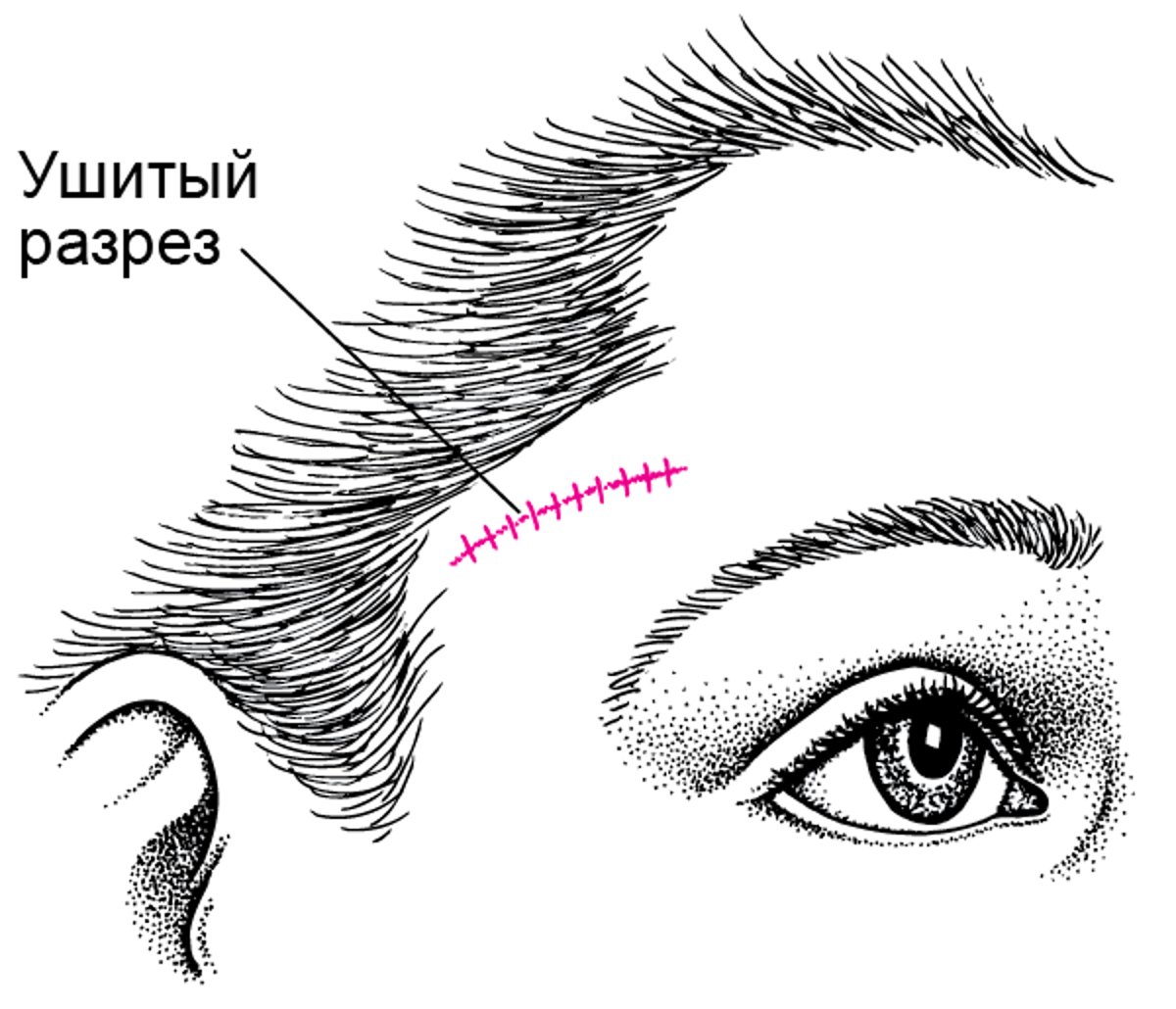 Биопсия височной артерии