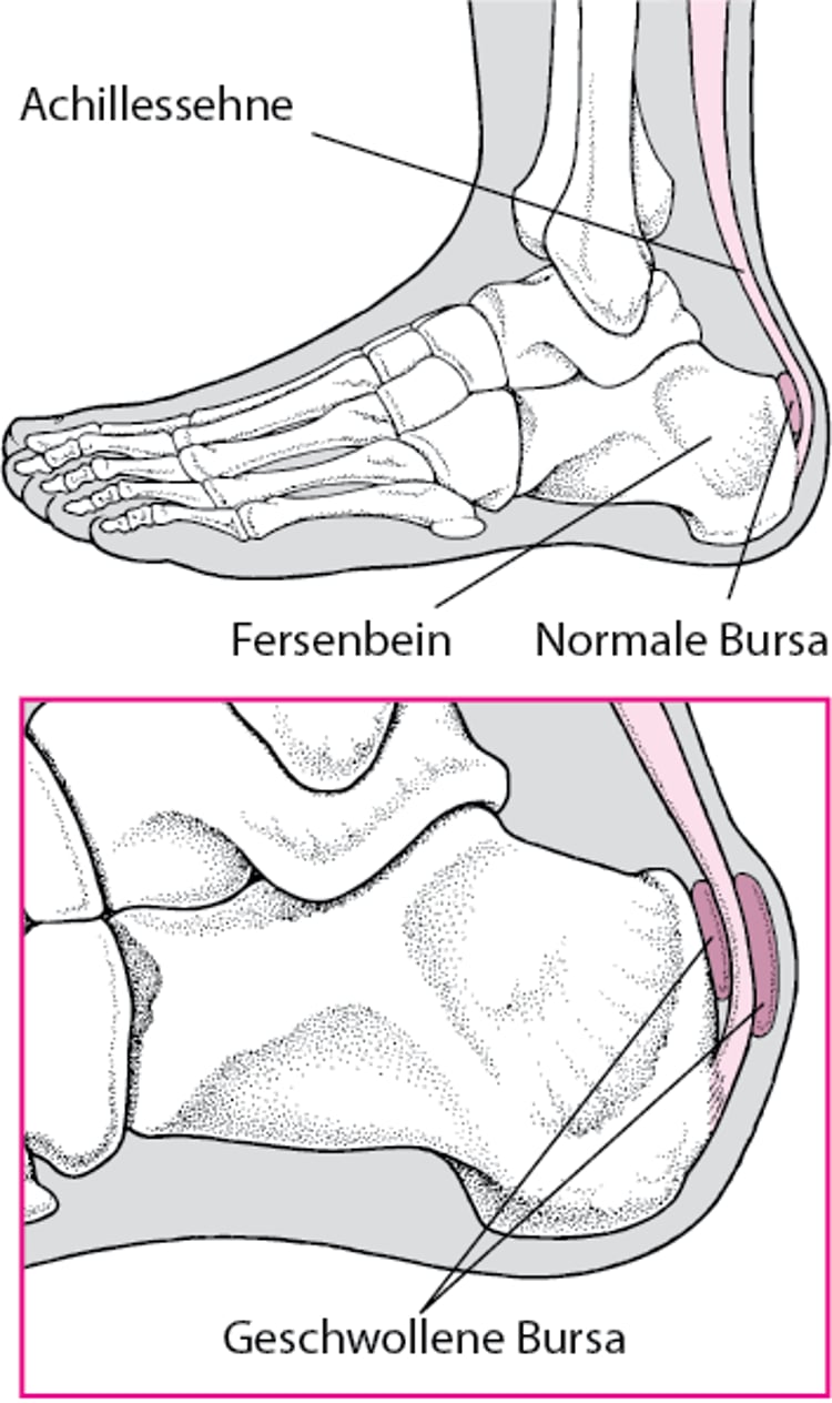 Schleimbeutelentzündung an der Ferse