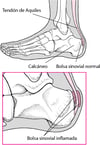 Bursitis en el talón