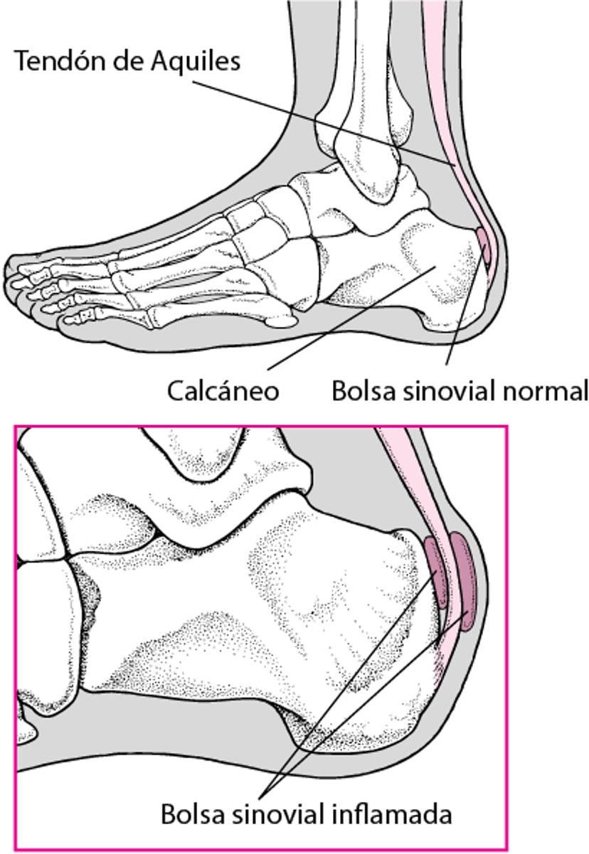 Bursitis en el talón