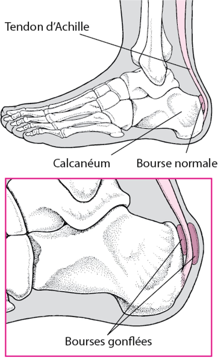 Bursite du talon