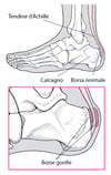 Borsite calcaneare