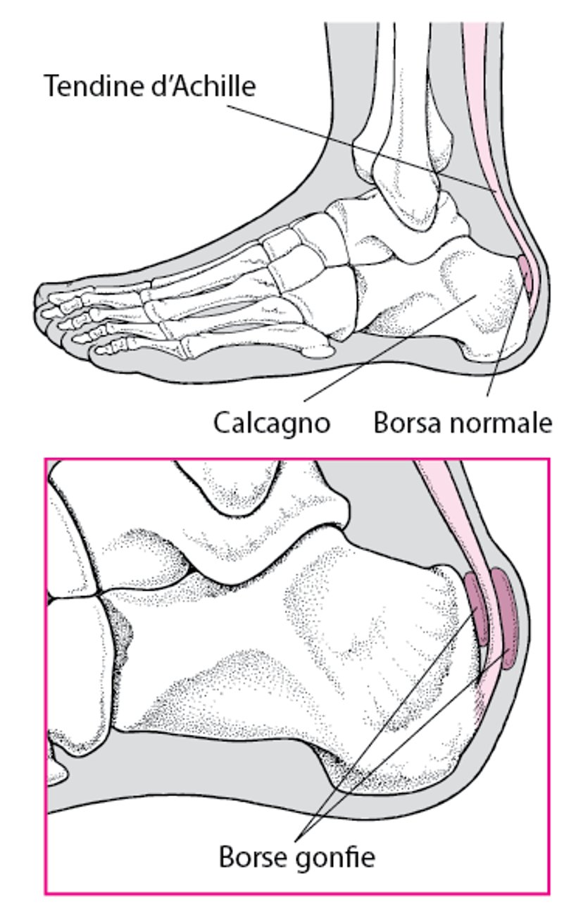 Borsite calcaneare