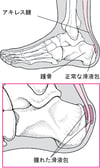 かかとの滑液包炎