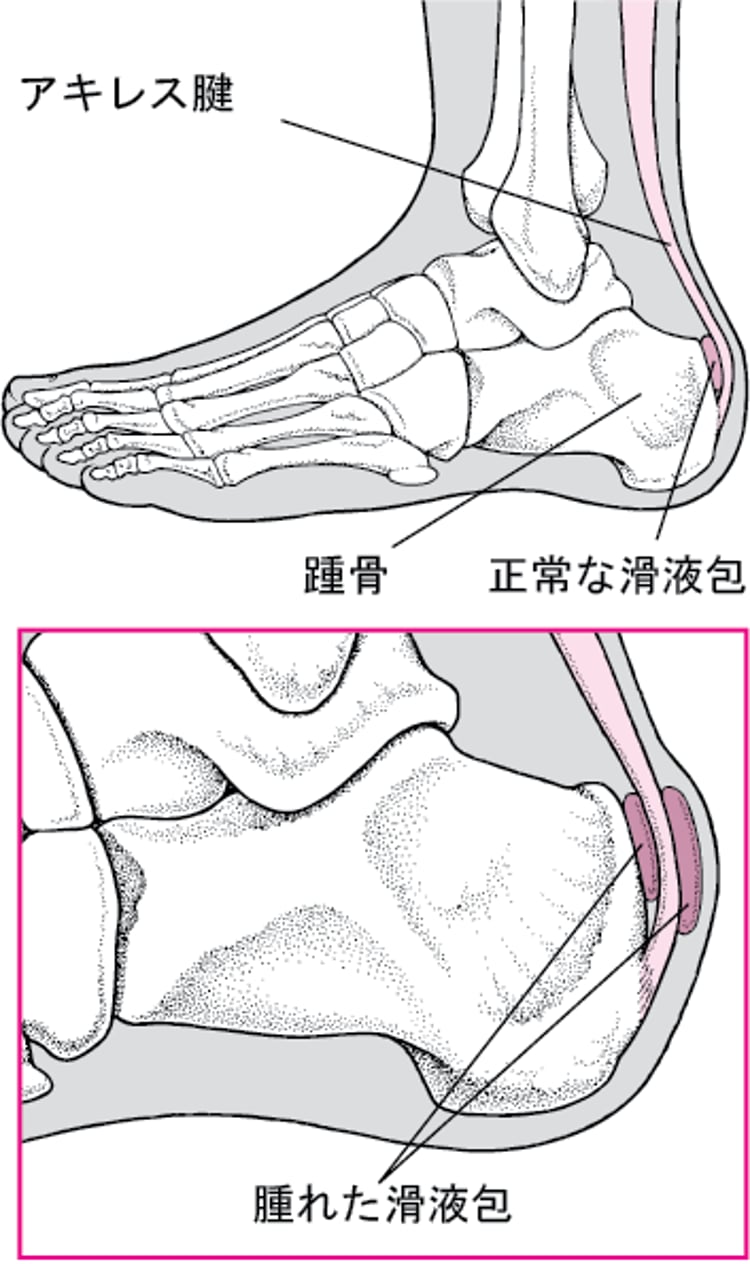 かかとの滑液包炎