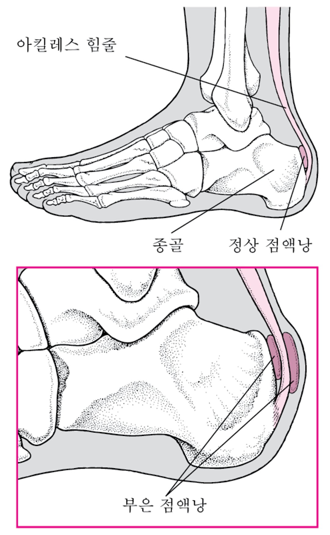 발뒤꿈치 윤활낭염