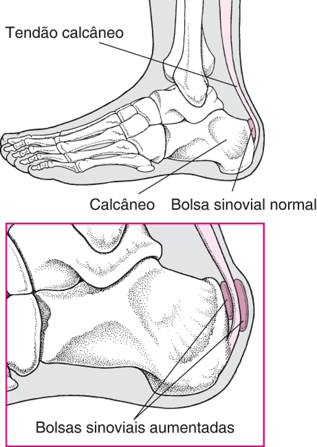 Bursites no calcanhar