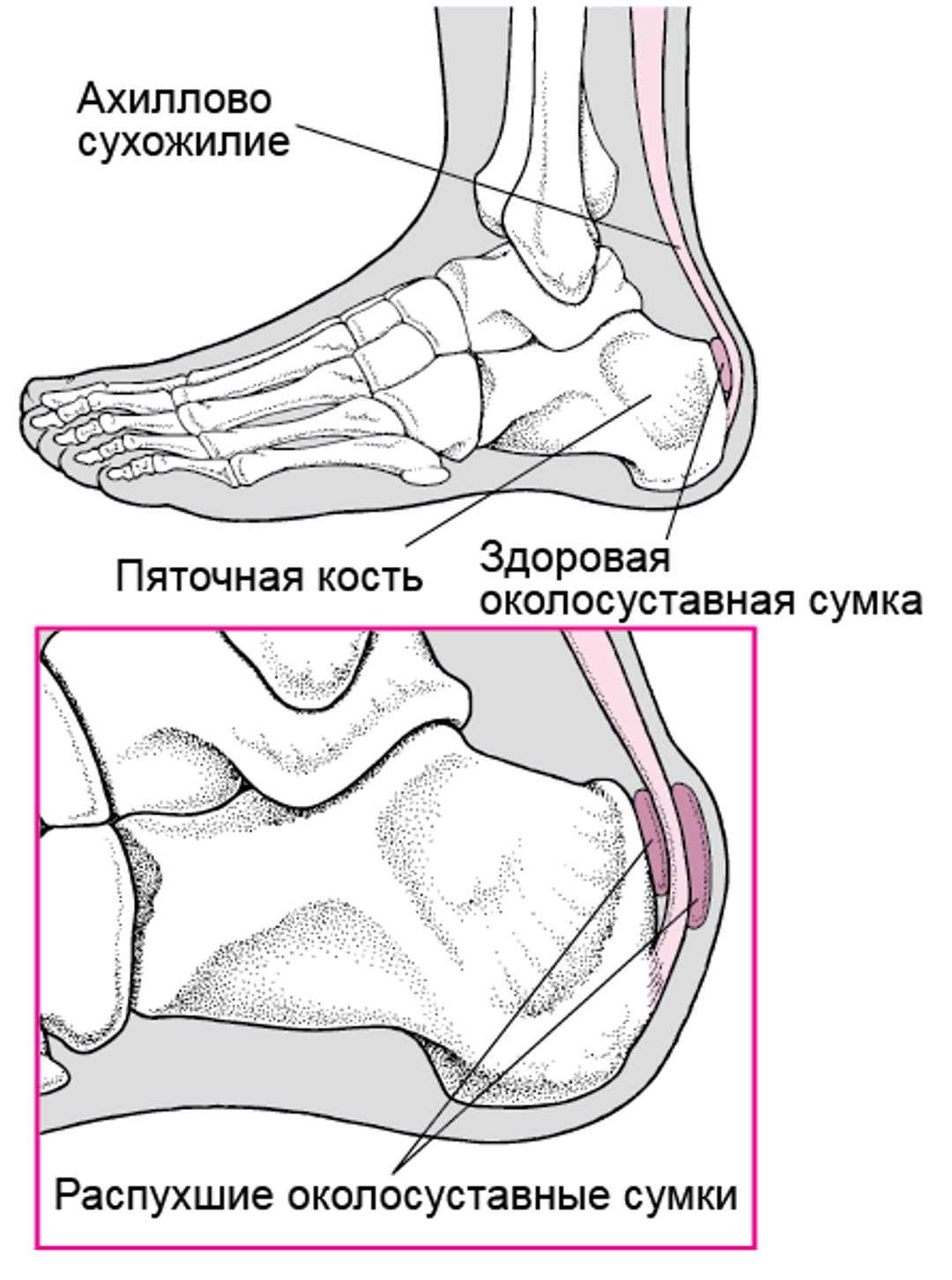 Бурсит пятки