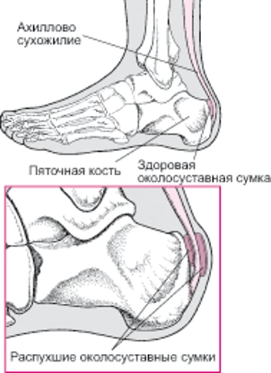Бурсит пятки