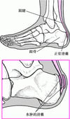 跟部滑囊炎