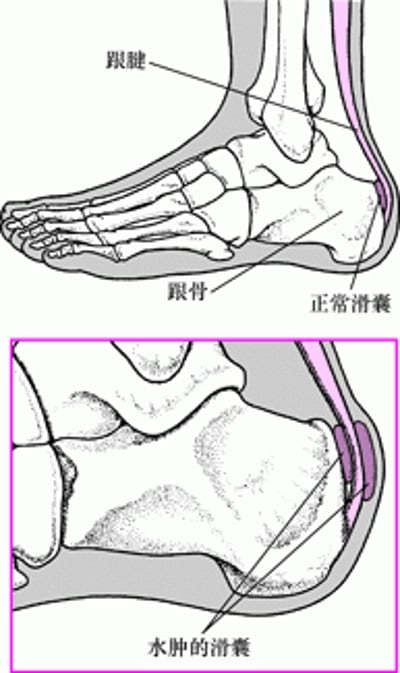 跟部滑囊炎