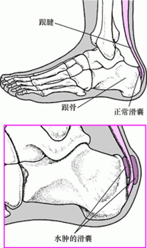 跟部滑囊炎